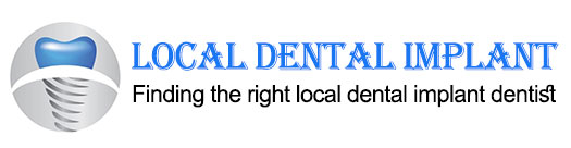 Best Online Local Dental Implant Blogging at Local Dental Implant