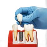 Local Dental Implant Blogging about Live Dental Implant Consultation